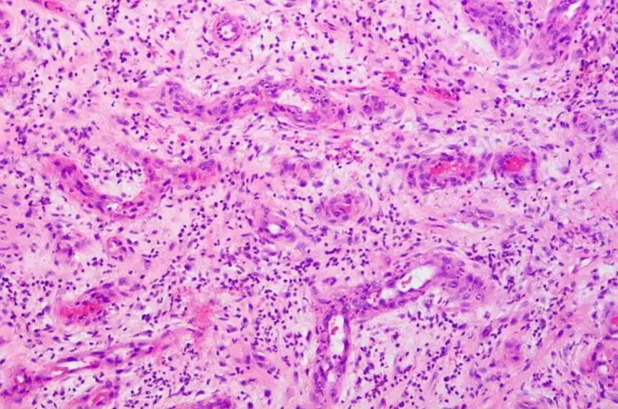 机化性肺炎平时应注意什么,机化性肺炎的正规治疗