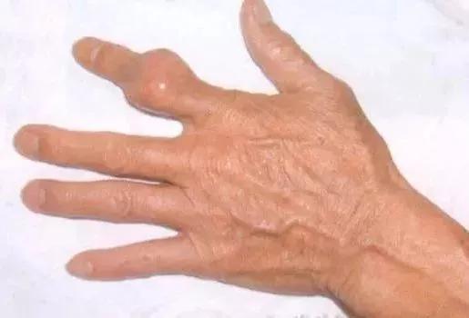 肚子鼓鼓的怎么瘦肚子,肚子大应该减肥还是减脂