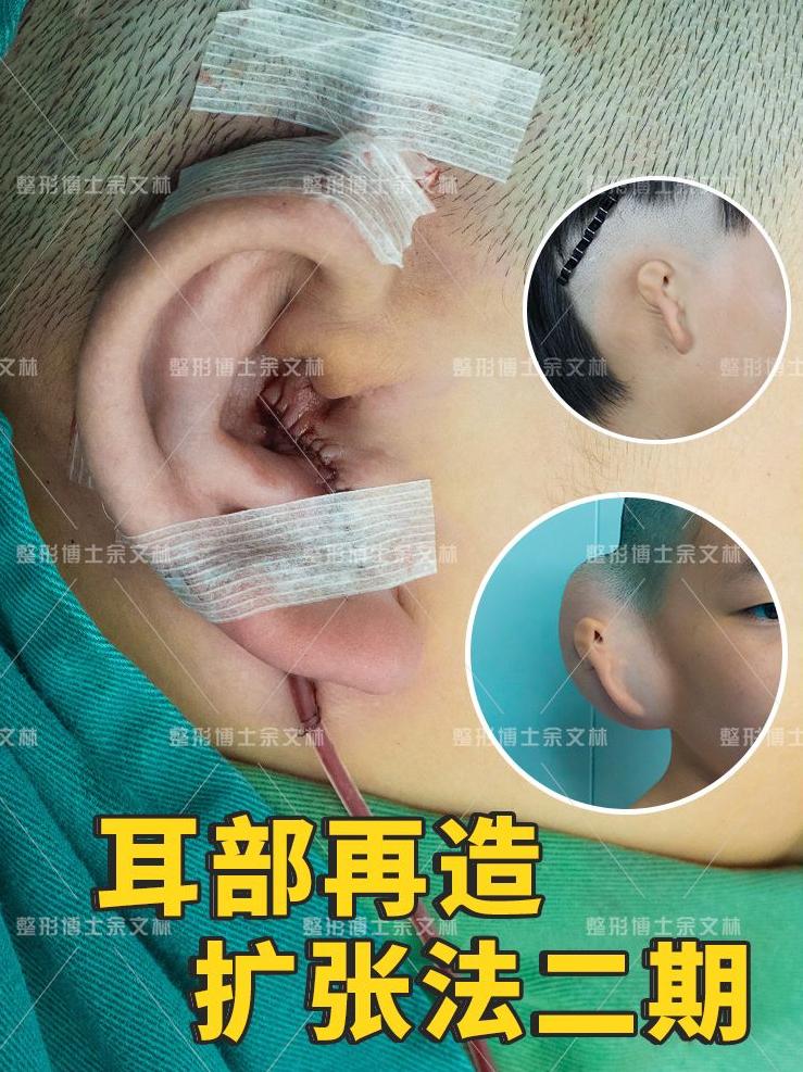 小耳畸形再造后的耳朵能用一辈子吗？为什么有的人会支架外露？