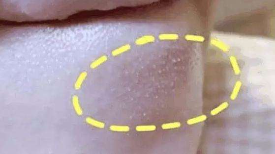 脂肪粒去粒神器 (日本自动消除脂肪粒)