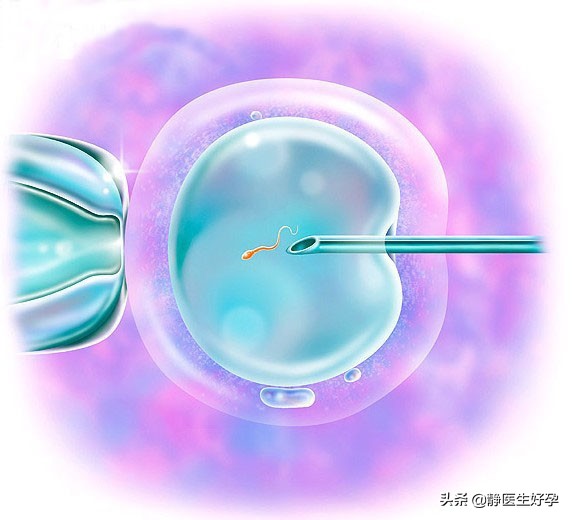 促排卵对胎儿及身体有影响吗,促排卵怎么避免对卵巢过度刺激