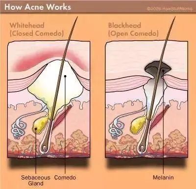 挤不出来的粉刺是什么,挤不出来的闭口自己能消失么
