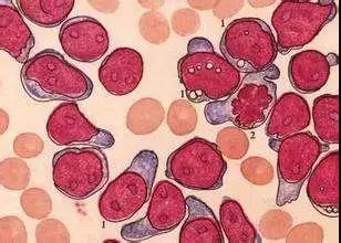 白血病骨髓肿瘤能治好吗怎么治疗,慢性骨髓白血病是怎么引起的