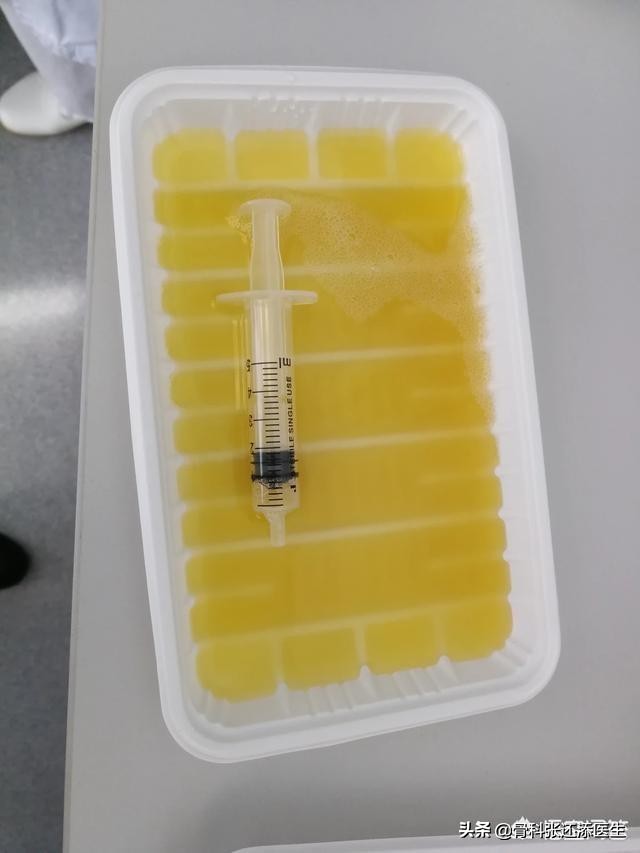 花椒治疗滑膜积液,花椒和食盐治疗膝关节积液吗