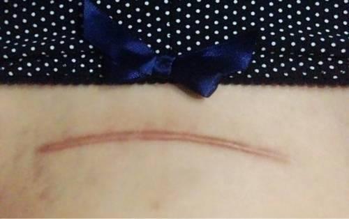 年轻妈妈顺产剖腹产亲身经历,顺产or剖腹产的感受