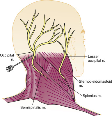 后脑勺一下一下的痛和颈椎有关系吗？枕神经痛的原因、特点和治疗