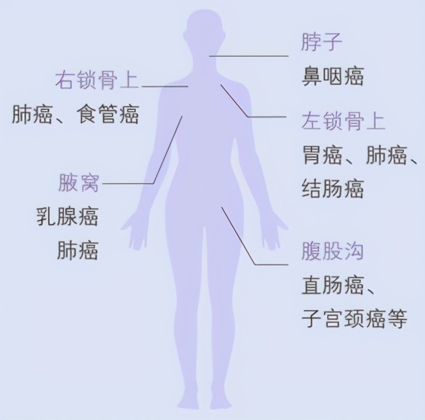 炎症和肿瘤引发的淋巴结肿大区别,摸到淋巴结就一定是癌症吗