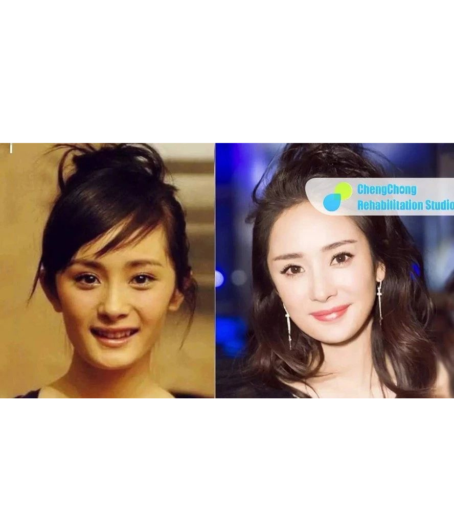 丰太阳穴可以改变脸型吗,如何丰脸颊和太阳穴