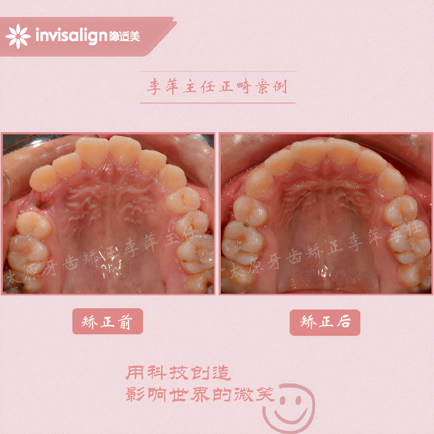 深覆合牙齿矫正不拔牙打骨钉,太原矫正牙齿需要做正颌吗