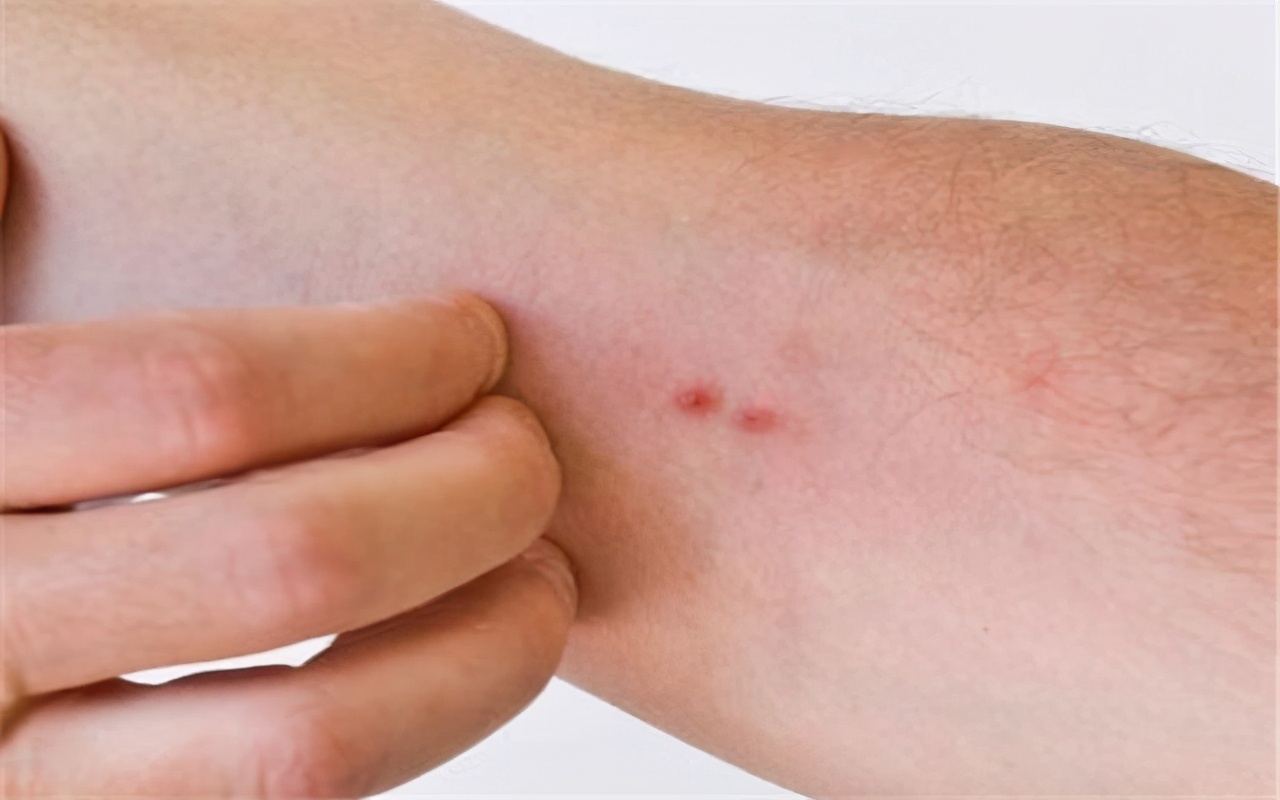 艾滋病出现皮肤变化就是艾滋病吗,艾滋病的早期表现别以为是皮肤病