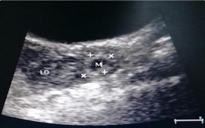 异位妊娠的诊断和治疗，女性朋友都应该知道