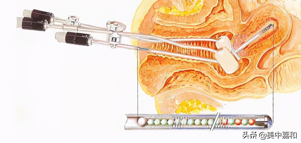 早期癌症全切能根治吗,早期癌症切除了就没事了吗