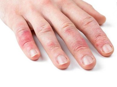 冬季冻疮高发如何预防是关键,冻疮怎么应对