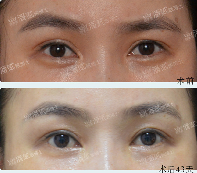双眼皮修复有失败的吗,双眼皮修复失败了会怎样