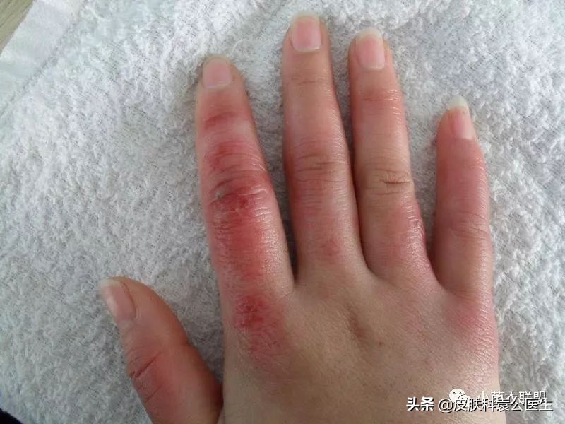 冻伤后痒痒是怎么回事,冻疮后期接触水干燥发痒怎么治