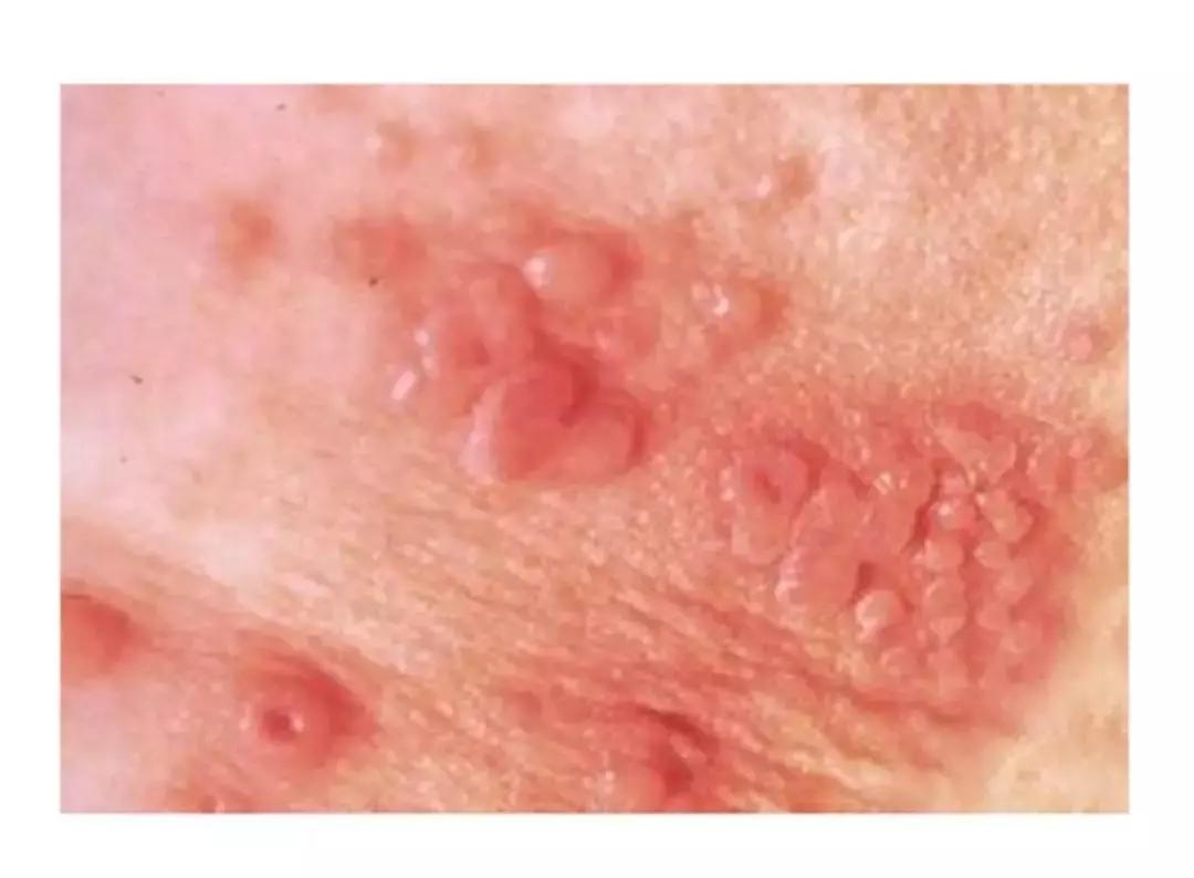 生殖器疱疹长在哪,哪里长带状疱疹最危险