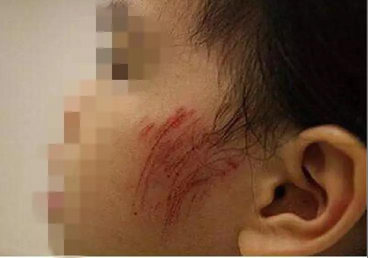 孩子不小心受伤了怎样问老师,孩子不小心摔伤怎么处理