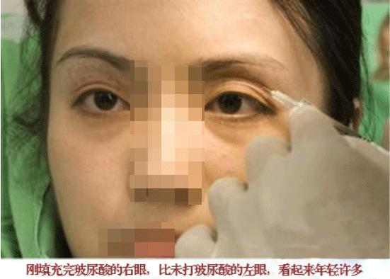 20岁眼睛凹陷是什么原因呢,眼眶会随着年龄变大凹陷