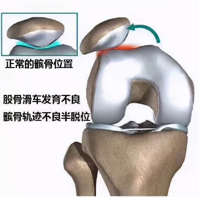 不同部位膝关节,骨科医生教你一招搞定膝盖痛