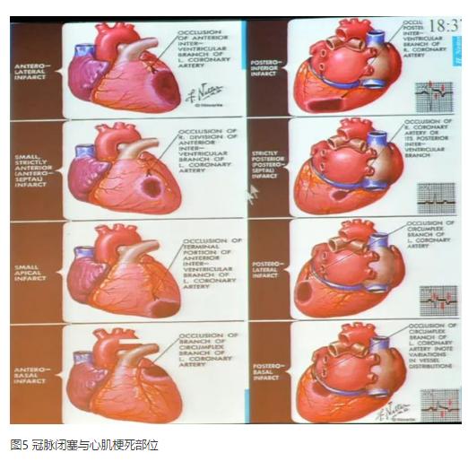 清晰完整揭秘冠脉造影全部过程,冠脉造影教学视频