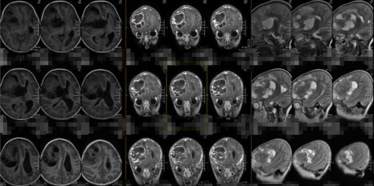 五岁的儿童发现两个特别大的肿瘤,2岁小孩脑部患罕见肿瘤