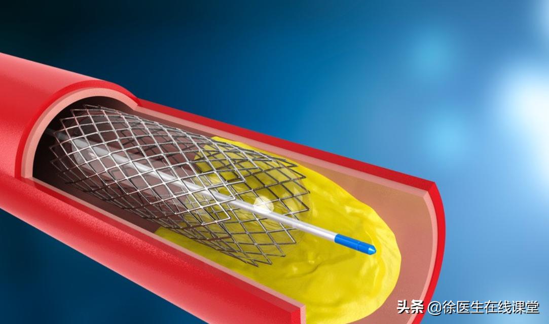 心脏三根血管都堵80%需要下支架吗,下了心脏支架血压低是什么问题