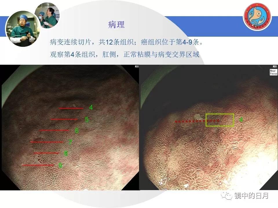 低分化胃癌早期时候做内镜手术吗,早期胃癌内镜手术后追加外科手术