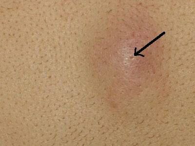 预防粉瘤,脂肪瘤怎样预防及治疗