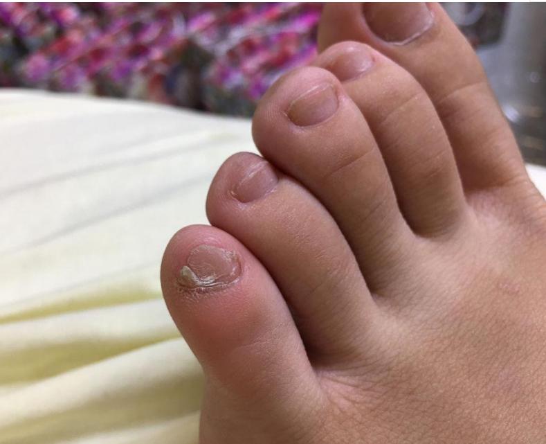 为什么人的小脚指甲是两半的,汉族人脚趾甲分成两半是什么原因