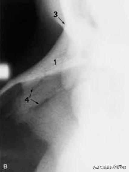 「鼻骨彩图」鼻骨CT解剖及骨折影像学诊断