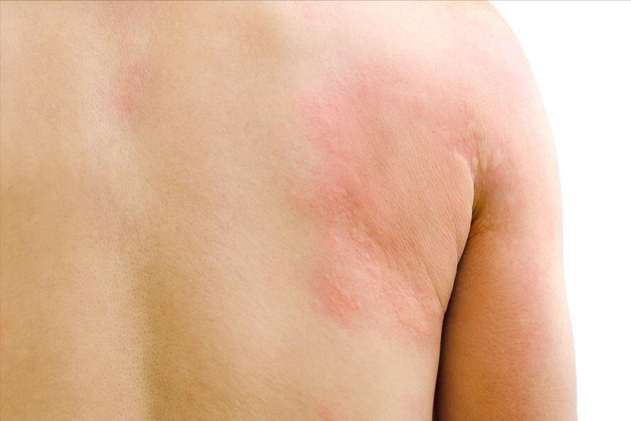 夏季荨麻疹高发期如何应对,麻疹最快的解决方法