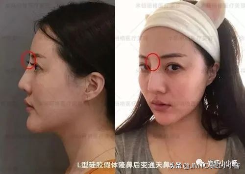 鼻子怎么修复好看呢,鼻型修复方法大全