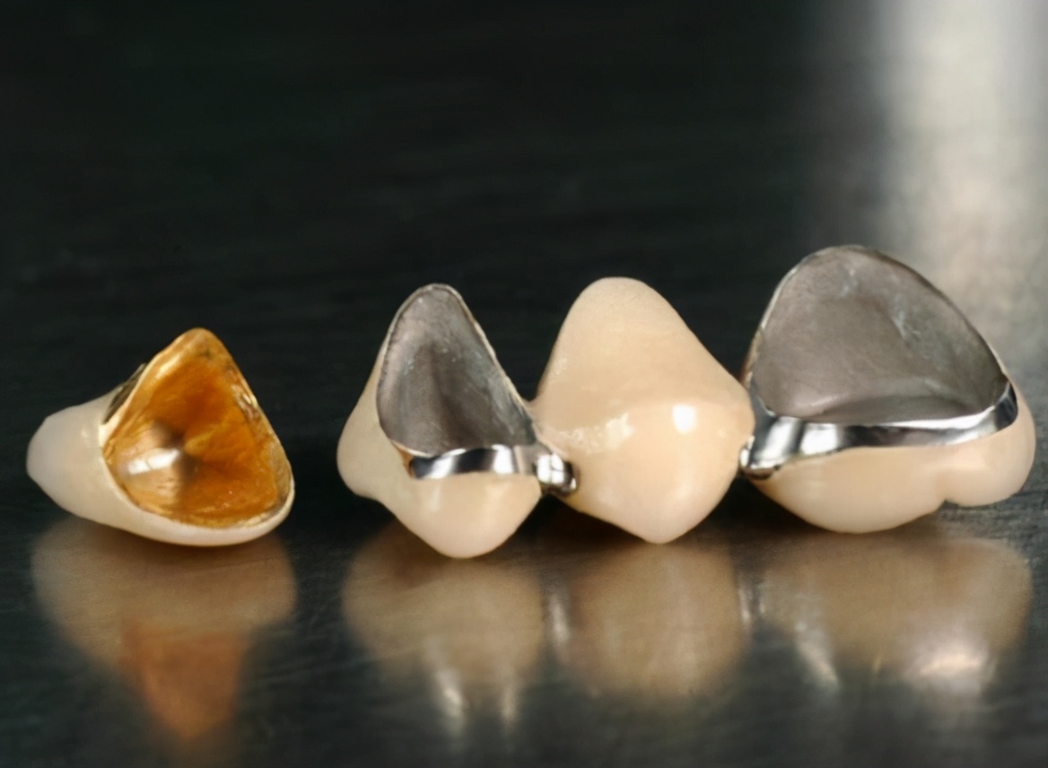 带牙冠里的牙齿烂掉了怎么办,戴的牙冠掉了发现牙根发黑