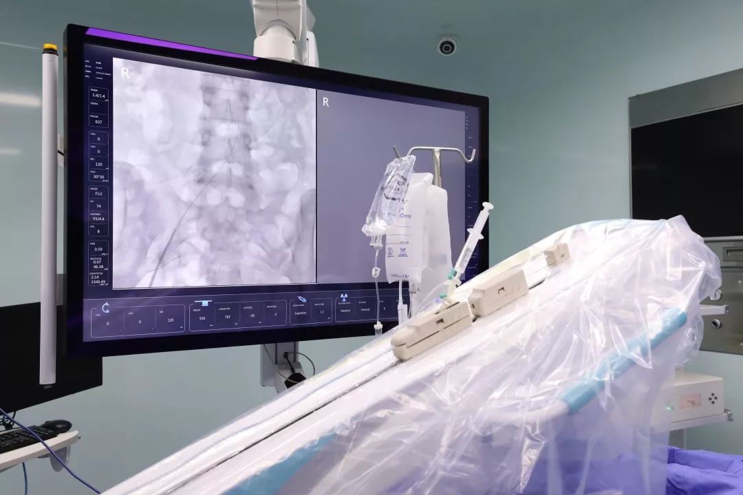 脑血管介入机器人,机器人脑血管造影