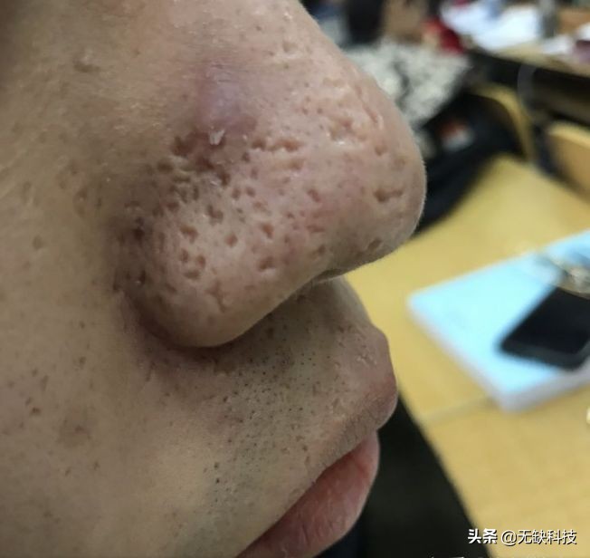 不管黑头的后果,不管黑头行吗