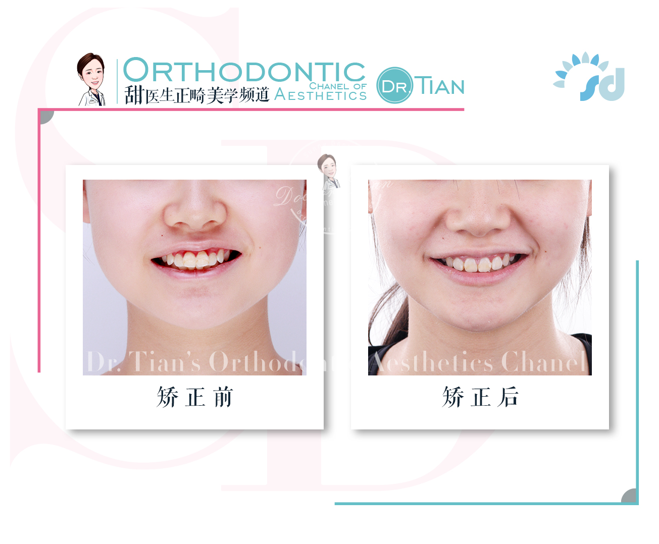 成年人第二磨牙锁合还能矫正吗,西安哪家医院牙齿深覆合矫正好