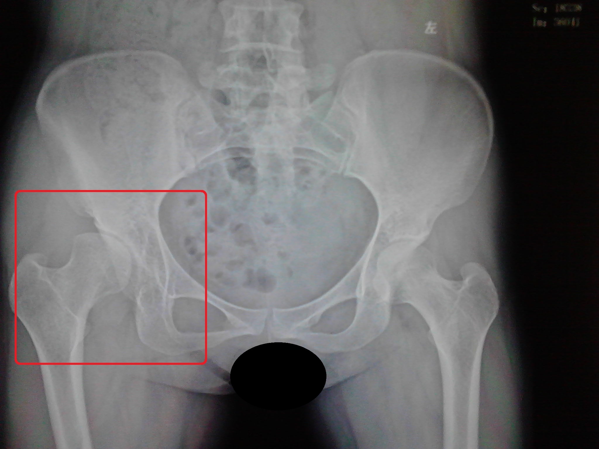 髋关节发育不良吃什么药效果最好,轻微髋关节发育不良可以不治疗吗