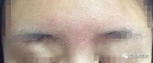 头皮脂溢性皮炎头皮屑发红,银屑病和脂溢性皮炎头皮屑的区别