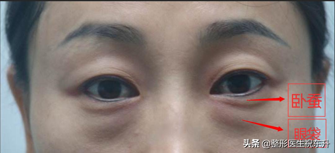 分享祛眼袋我的真实经历,关于祛眼袋你一定有好多疑问