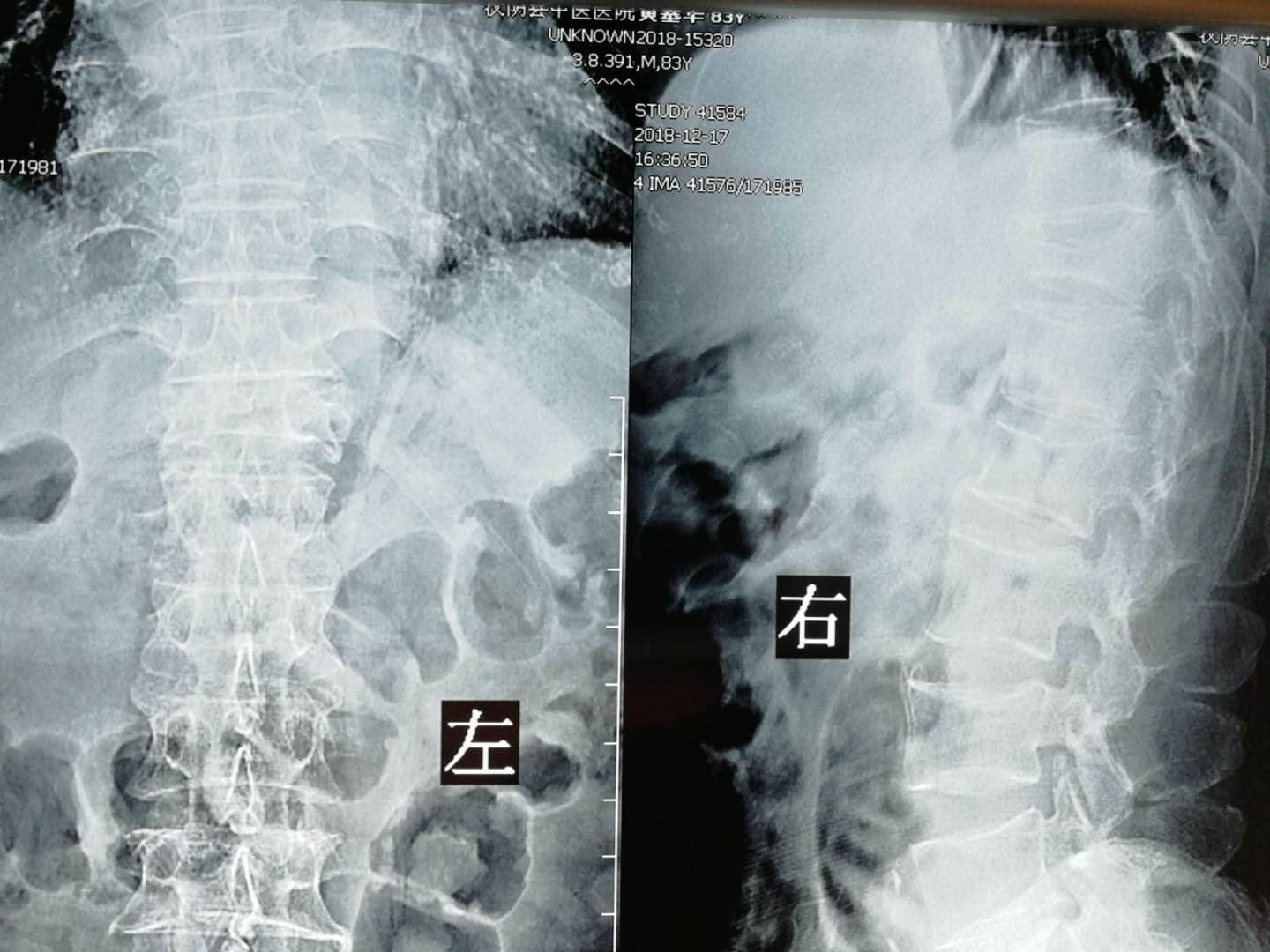 汉阴县中医医院微创手术治疗骨质疏松型骨折