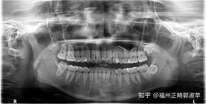 牙齿龅牙矫正过程全记录33岁,大龅牙牙齿矫正成功案例和费用
