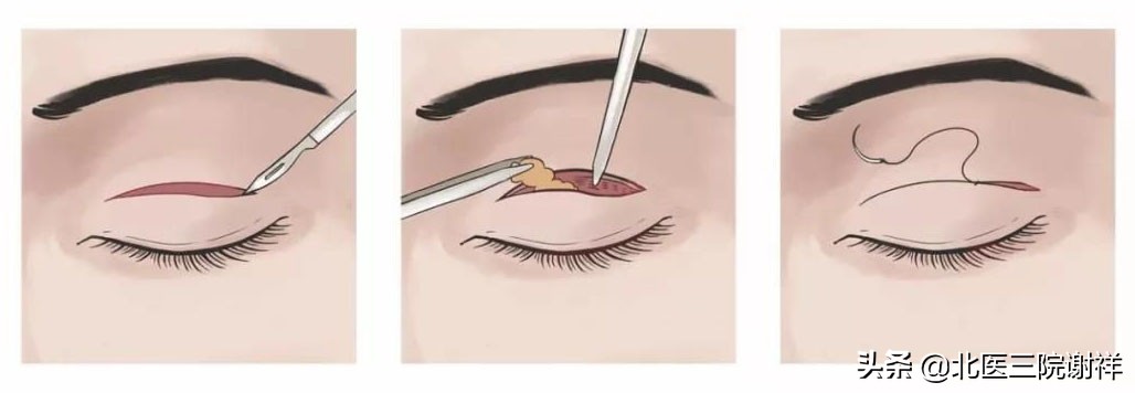 双眼皮长成内双了是怎么回事,双眼皮变成肉条的原因