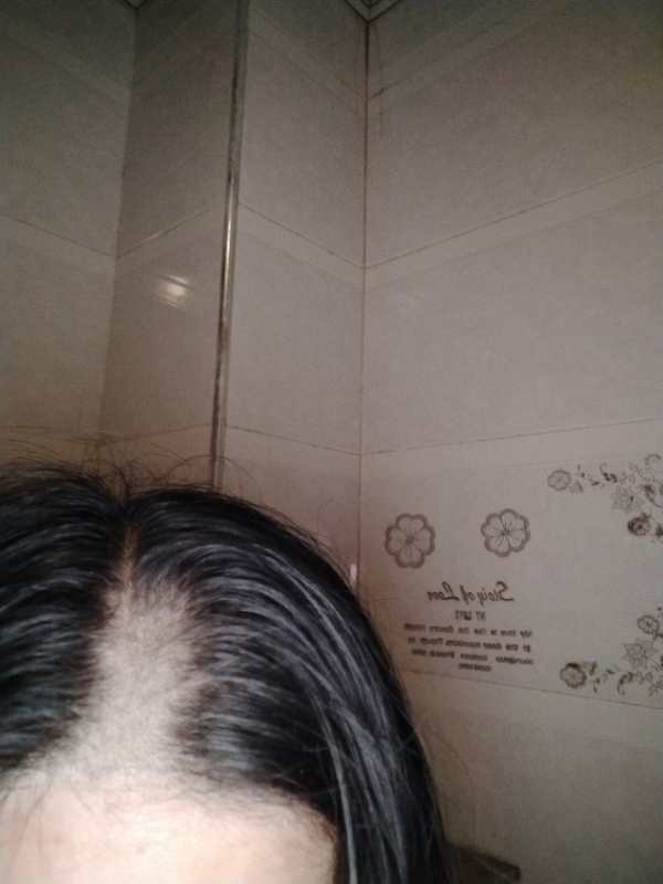 女子称入住酒店一觉醒来头秃一块酒店：无人进入房间