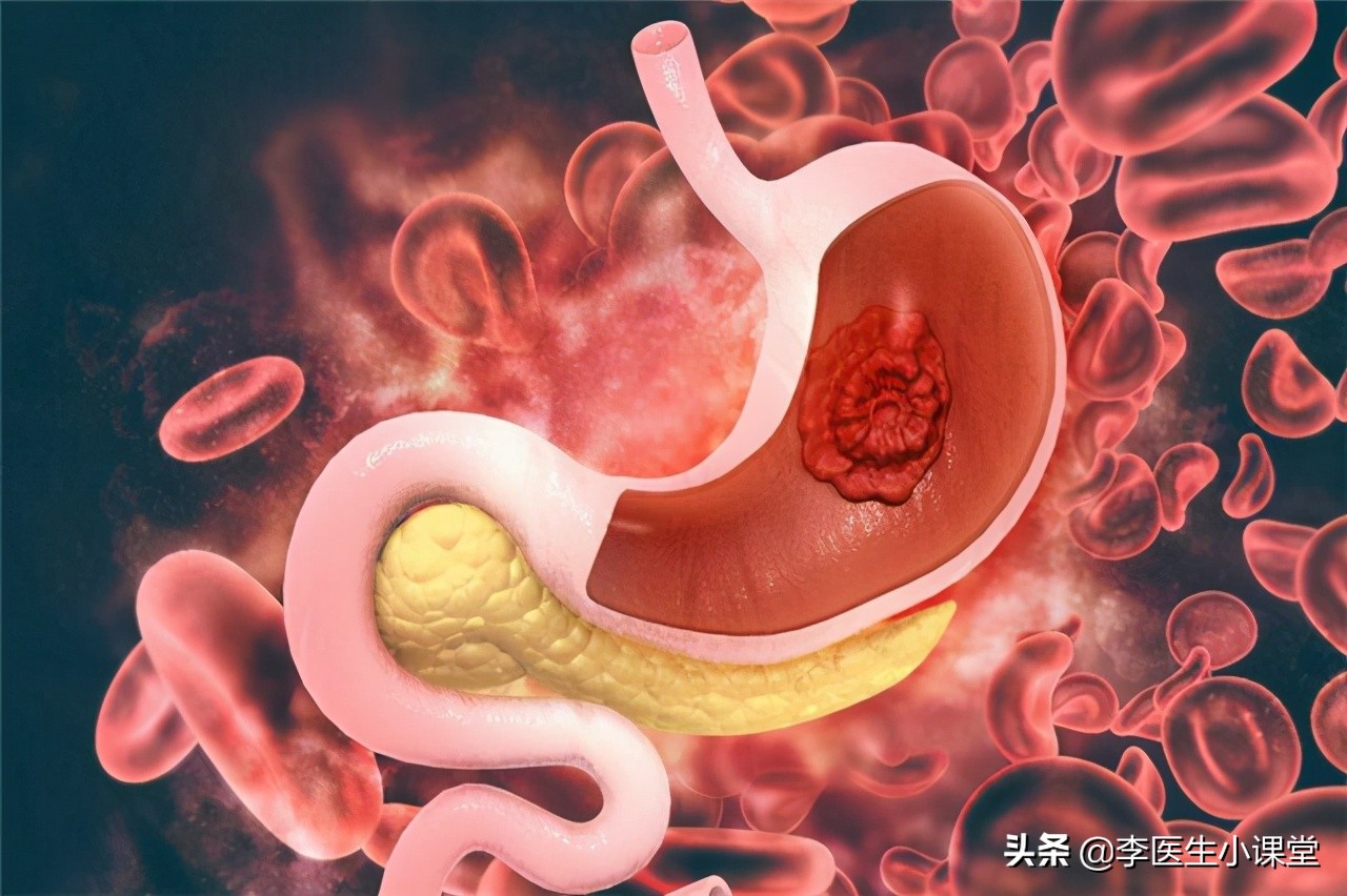 患胃癌前会经历两阶段！在第一阶段改善胃环境，便可逆转癌前疾病