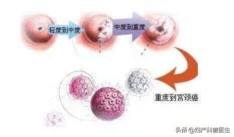 20岁女性得宫颈癌的前兆,20岁就得宫颈癌前病变