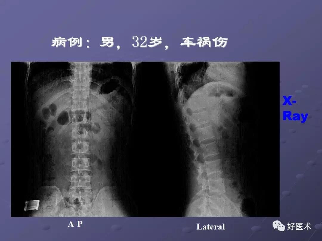 脊柱mri有哪些特点,乳腺疾病的mri诊断及鉴别