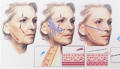 线雕面部提升是做什么的,面部线雕提升都做什么