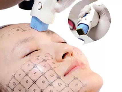 热拉提热玛吉fotona4d怎么选,热拉提抗衰