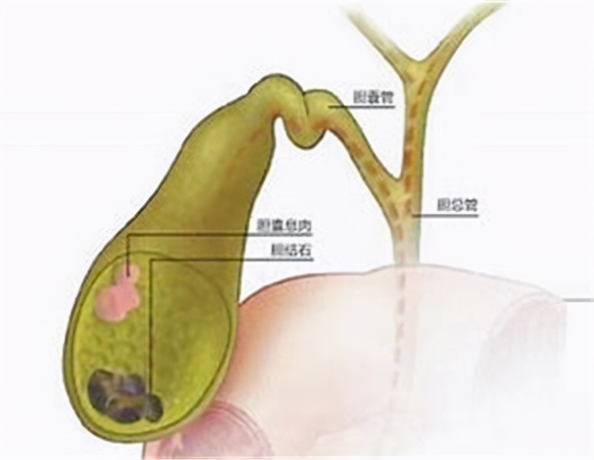 胆囊炎为啥不能吃鸡蛋,胆囊炎能吃鸡蛋和鱼吗