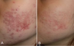 不同痘坑凹洞擦什么药膏,不同痘坑怎么修复